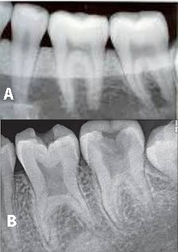 molar teeth normal taurodont